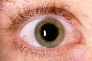Oftalmologista faz alerta sobre a importância do diagnóstico precoce do glaucoma
